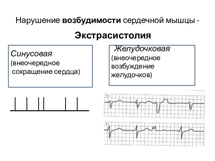 Нарушение возбудимости сердечной мышцы - Экстрасистолия Синусовая (внеочередное сокращение сердца) - Желудочковая (внеочередное возбуждение желудочков)