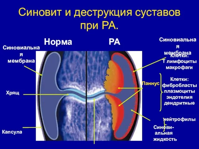 Синовит и деструкция суставов при РА. Норма РА Синовиальная мембрана