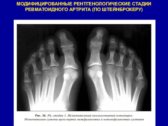 МОДИФИЦИРОВАННЫЕ РЕНТГЕНОЛОГИЧЕСКИЕ СТАДИИ РЕВМАТОИДНОГО АРТРИТА (ПО ШТЕЙНБРОКЕРУ)