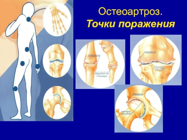 Остеоартроз. Точки поражения