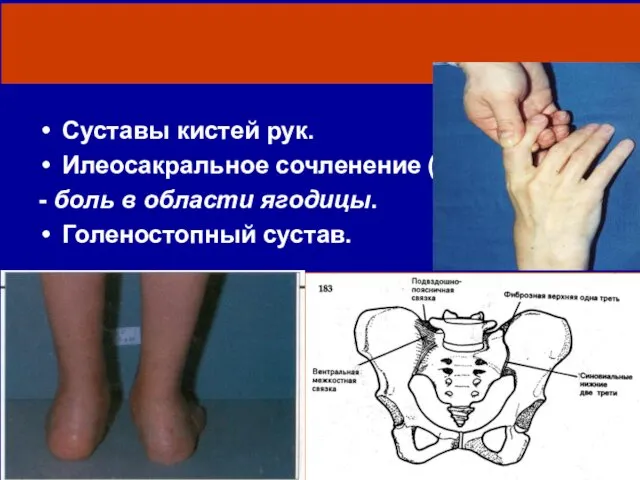 Какие суставы поражены? Суставы кистей рук. Илеосакральное сочленение (сакроилеит) - боль в области ягодицы. Голеностопный сустав.