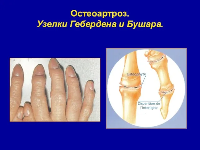 Остеоартроз. Узелки Гебердена и Бушара.
