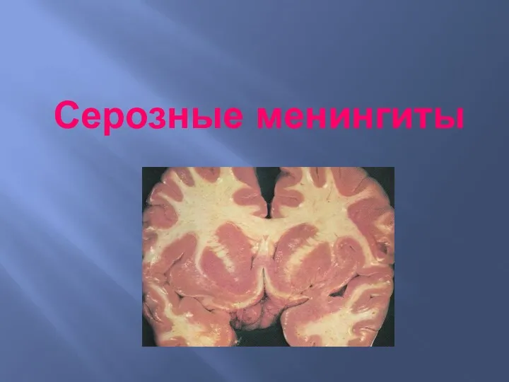 Серозные менингиты