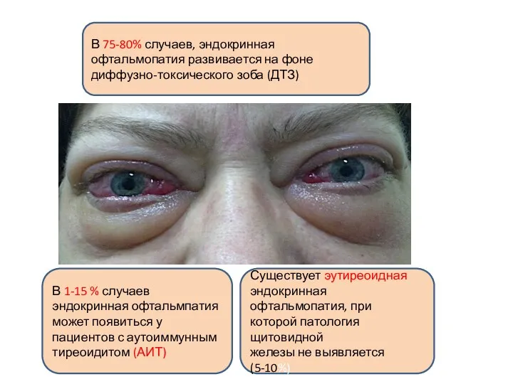 В 75-80% случаев, эндокринная офтальмопатия развивается на фоне диффузно-токсического зоба (ДТЗ) В 1-15