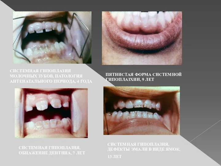 СИСТЕМНАЯ ГИПОПЛАЗИЯ МОЛОЧНЫХ ЗУБОВ, ПАТОЛОГИЯ АНТЕНАТАЛЬНОГО ПЕРИОДА, 4 ГОДА ПЯТНИСТАЯ