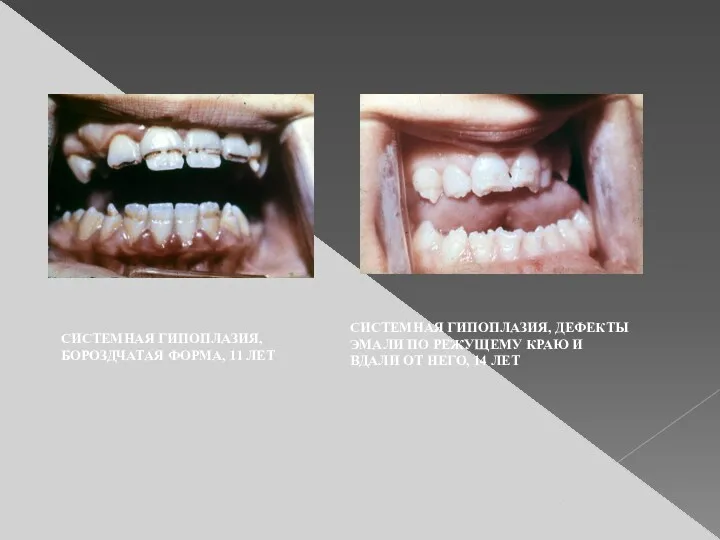 СИСТЕМНАЯ ГИПОПЛАЗИЯ, БОРОЗДЧАТАЯ ФОРМА, 11 ЛЕТ СИСТЕМНАЯ ГИПОПЛАЗИЯ, ДЕФЕКТЫ ЭМАЛИ