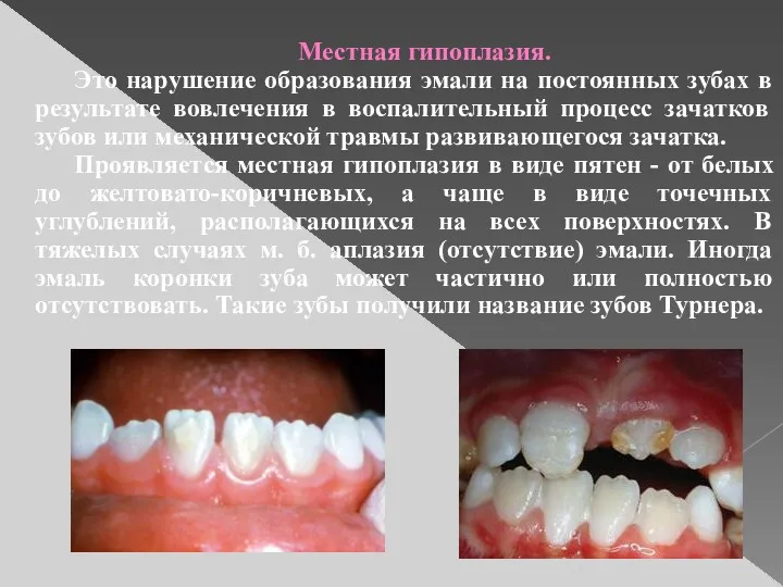 Местная гипоплазия. Это нарушение образования эмали на постоянных зубах в