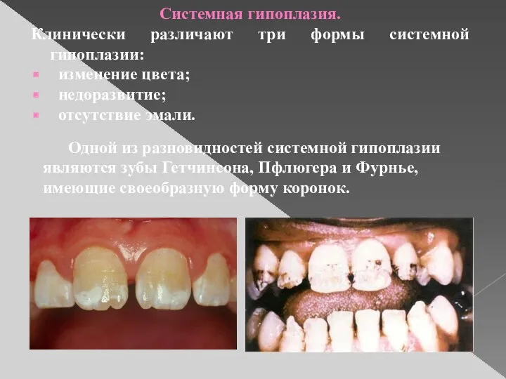 Системная гипоплазия. Клинически различают три формы системной гипоплазии: изменение цвета;