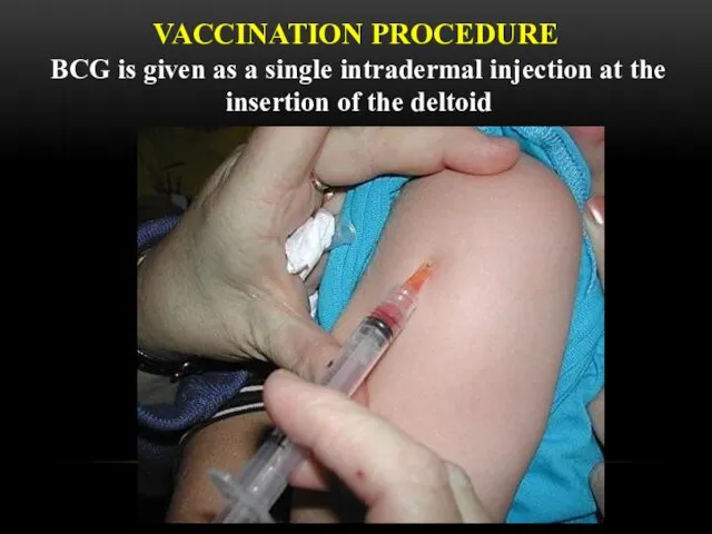 VACCINATION PROCEDURE BCG is given as a single intradermal injection at the insertion of the deltoid