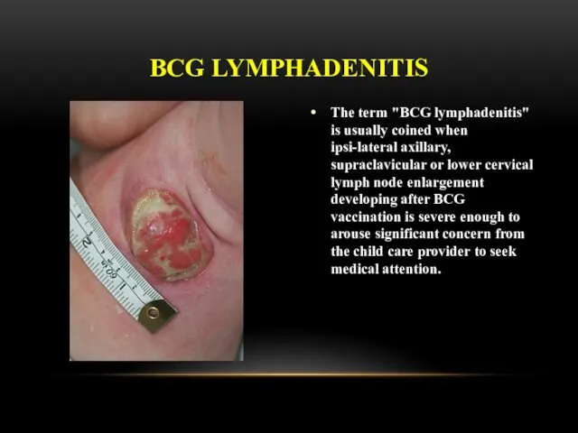 The term "BCG lymphadenitis" is usually coined when ipsi-lateral axillary,