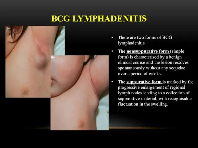 There are two forms of BCG lymphadenitis. The nonsuppurative form