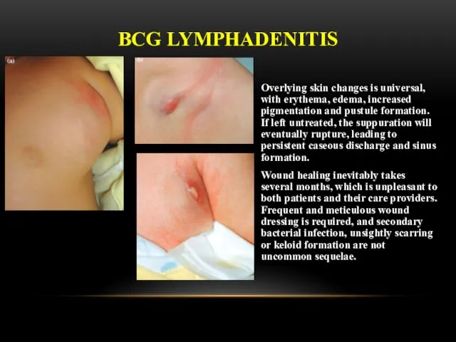 Overlying skin changes is universal, with erythema, edema, increased pigmentation