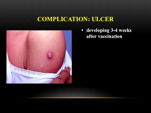 developing 3-4 weeks after vaccination COMPLICATION: ULCER