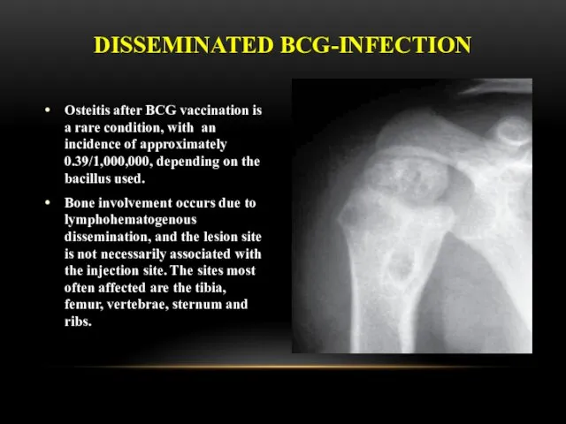 Osteitis after BCG vaccination is a rare condition, with an