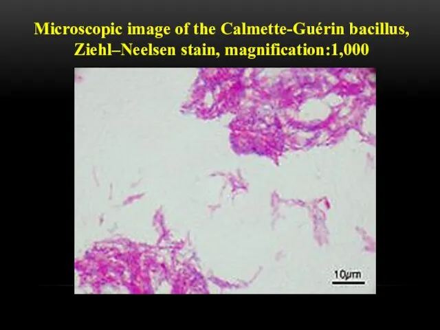 Microscopic image of the Calmette-Guérin bacillus, Ziehl–Neelsen stain, magnification:1,000