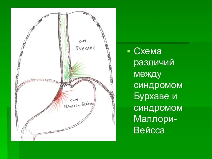 Схема различий между синдромом Бурхаве и синдромом Маллори-Вейсса