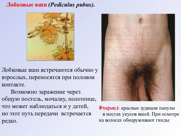 Лобковые вши (Pediculus рubus). Лобковые вши встречаются обычно у взрослых,