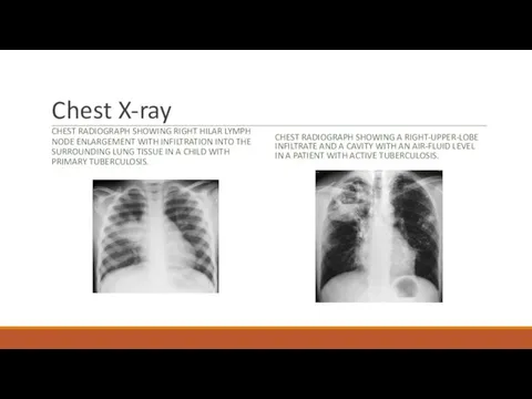 Chest X-ray CHEST RADIOGRAPH SHOWING RIGHT HILAR LYMPH NODE ENLARGEMENT