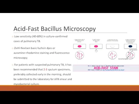 Acid-Fast Bacillus Microscopy Low sensitivity (40-60%) in culture-confirmed cases of