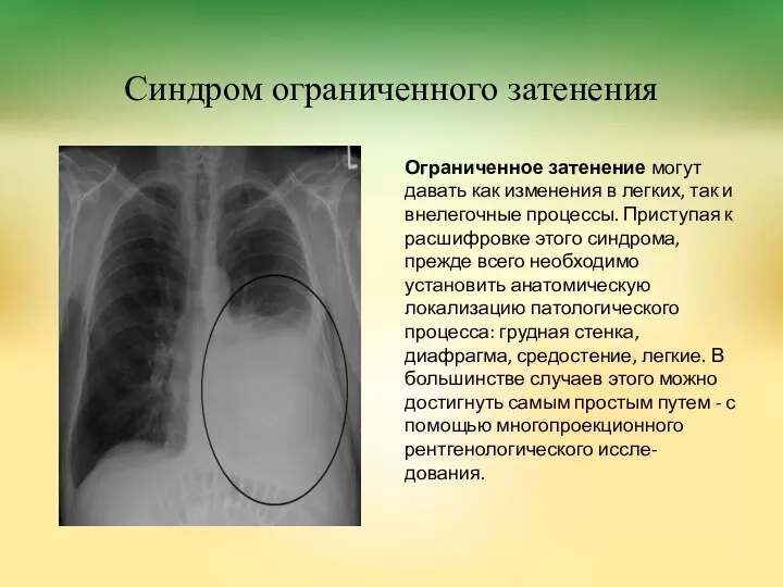 Синдром ограниченного затенения Ограниченное затенение могут давать как изменения в