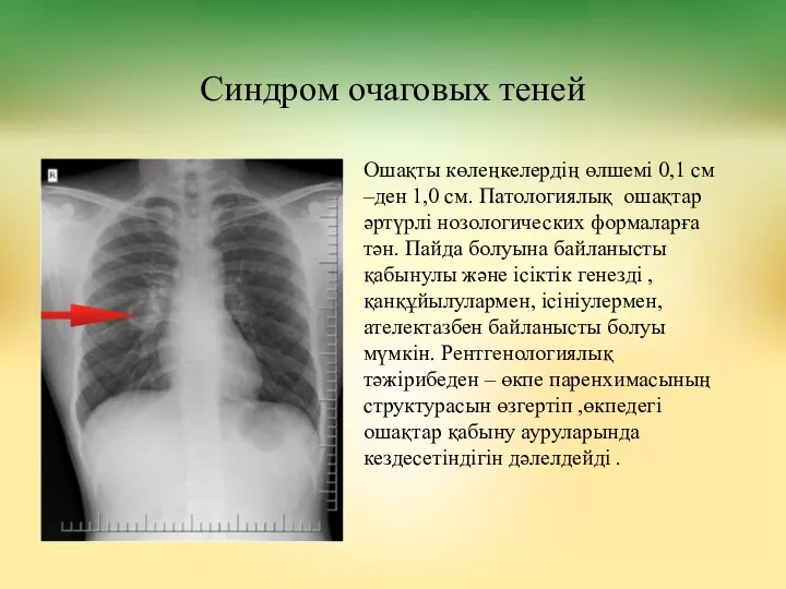 Синдром очаговых теней Ошақты көлеңкелердің өлшемі 0,1 см –ден 1,0