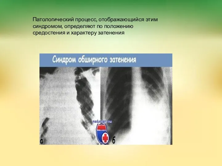 Патологический процесс, отображающийся этим синдромом, определяют по положению средостения и характеру затенения