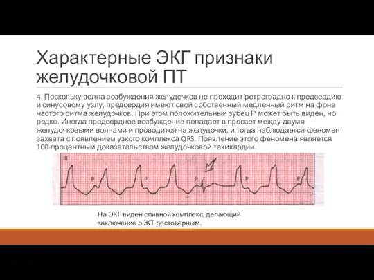 Характерные ЭКГ признаки желудочковой ПТ 4. Поскольку волна возбуждения желудочков