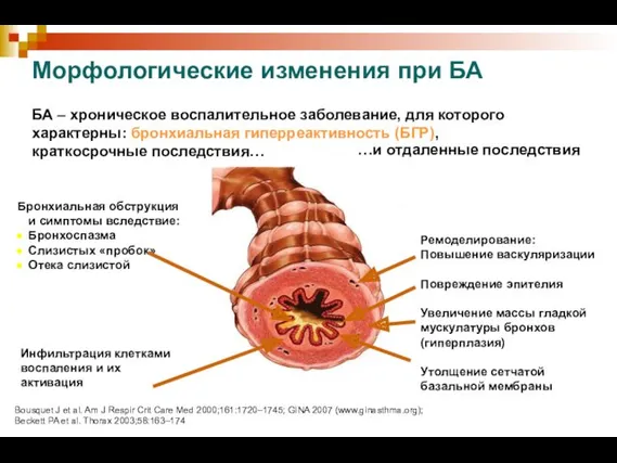 БА – хроническое воспалительное заболевание, для которого характерны: бронхиальная гиперреактивность