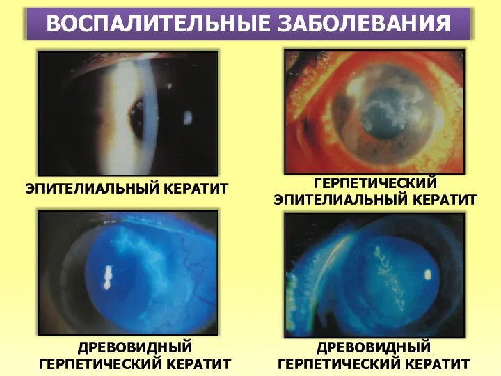 ВОСПАЛИТЕЛЬНЫЕ ЗАБОЛЕВАНИЯ ЭПИТЕЛИАЛЬНЫЙ КЕРАТИТ ГЕРПЕТИЧЕСКИЙ ЭПИТЕЛИАЛЬНЫЙ КЕРАТИТ ДРЕВОВИДНЫЙ ГЕРПЕТИЧЕСКИЙ КЕРАТИТ ДРЕВОВИДНЫЙ ГЕРПЕТИЧЕСКИЙ КЕРАТИТ