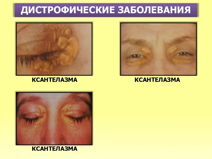 ДИСТРОФИЧЕСКИЕ ЗАБОЛЕВАНИЯ КСАНТЕЛАЗМА КСАНТЕЛАЗМА КСАНТЕЛАЗМА