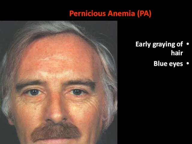 Pernicious Anemia (PA) Early graying of hair Blue eyes