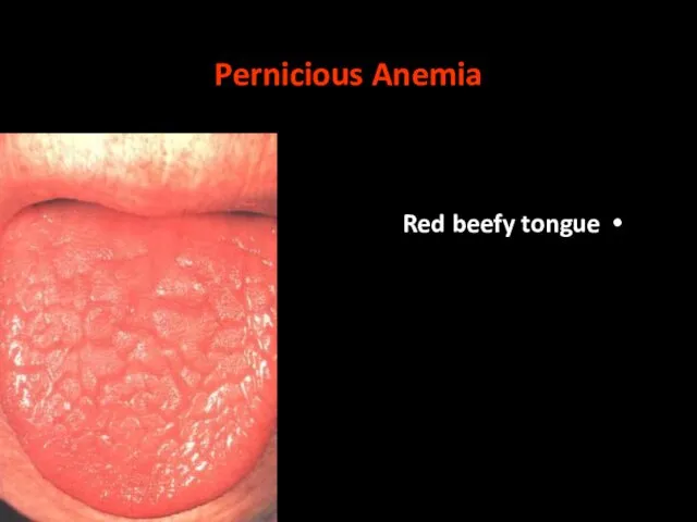 Pernicious Anemia Red beefy tongue