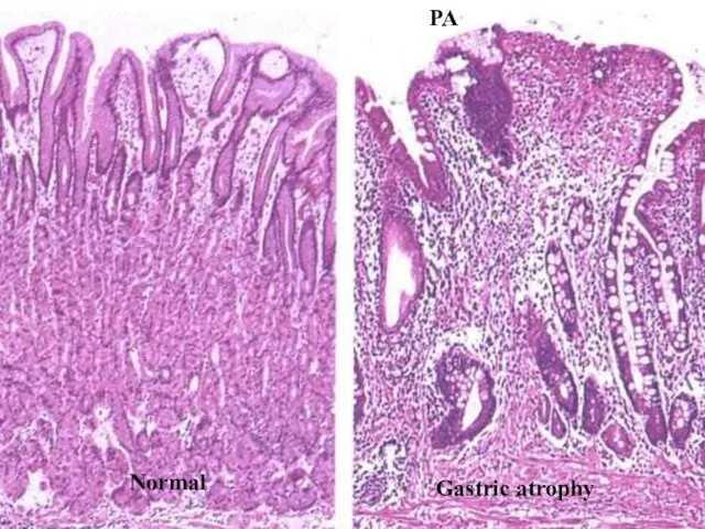 Normal Gastric atrophy PA