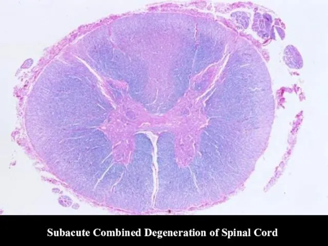 Subacute Combined Degeneration of Spinal Cord