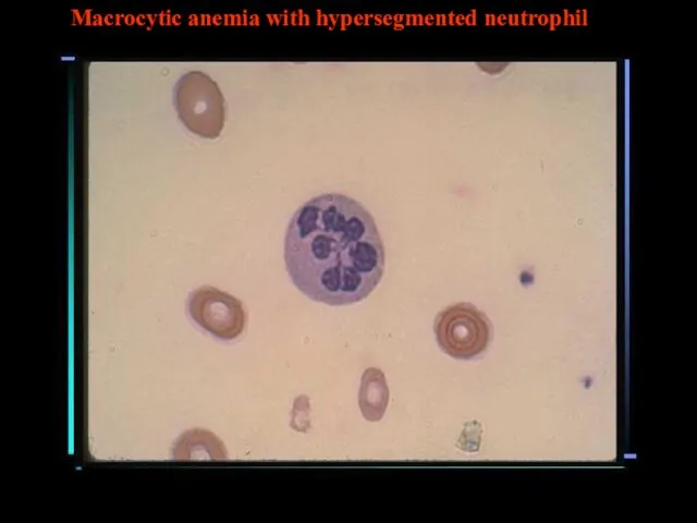 Macrocytic anemia with hypersegmented neutrophil