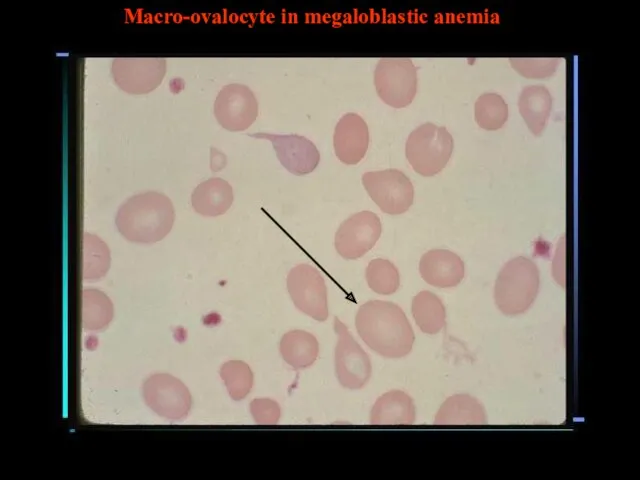 Macro-ovalocyte in megaloblastic anemia