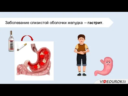 Заболевание слизистой оболочки желудка − гастрит.