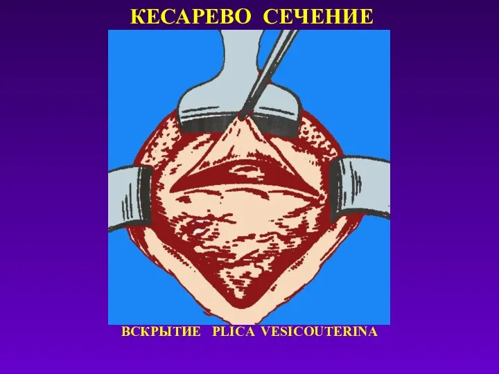 КЕСАРЕВО СЕЧЕНИЕ ВСКРЫТИЕ PLICA VESICOUTERINA