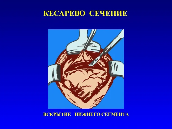 КЕСАРЕВО СЕЧЕНИЕ ВСКРЫТИЕ НИЖНЕГО СЕГМЕНТА