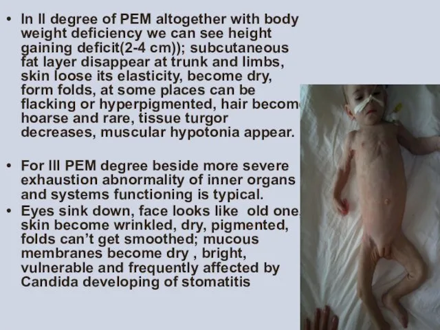 In II degree of PEM altogether with body weight deficiency