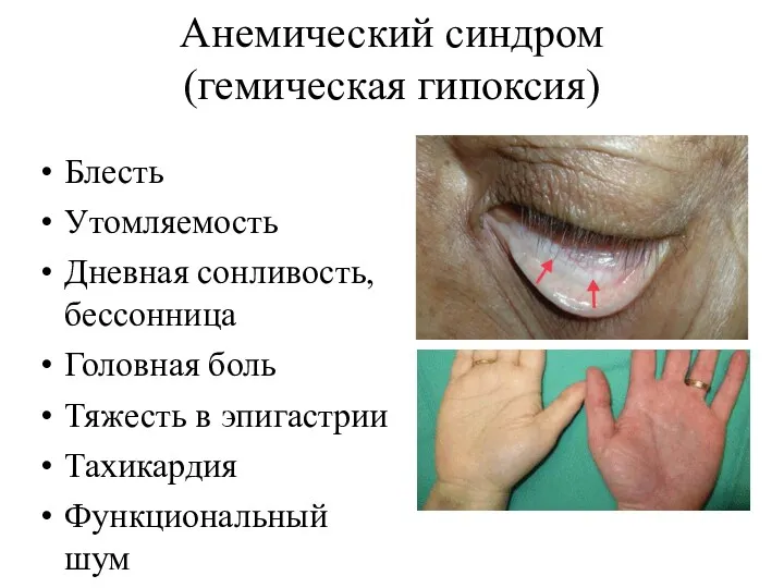 Анемический синдром (гемическая гипоксия) Блесть Утомляемость Дневная сонливость, бессонница Головная