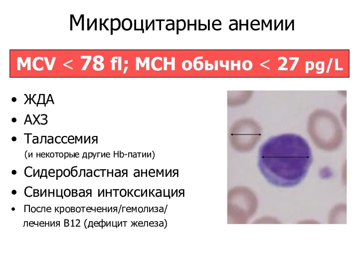 Микроцитарные анемии ЖДА АХЗ Талассемия (и некоторые другие Hb-патии) Cидеробластная