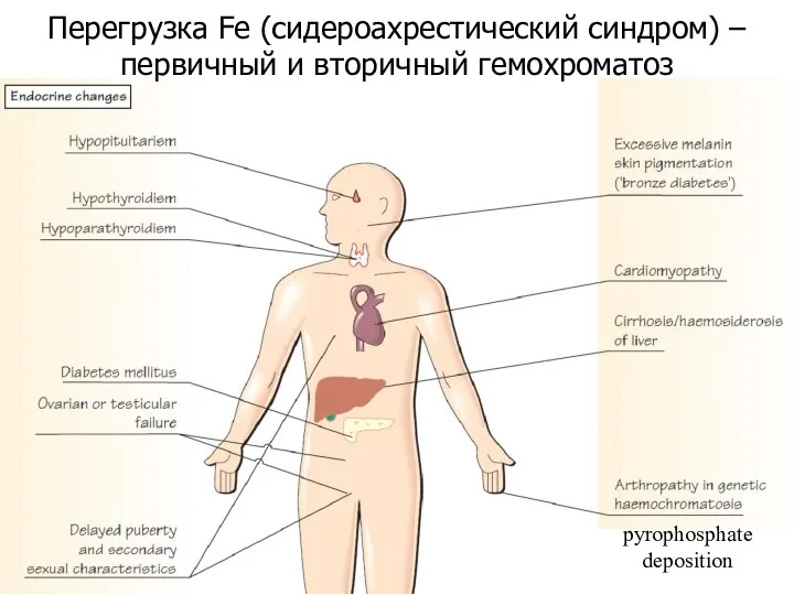 Перегрузка Fe (сидероахрестический синдром) – первичный и вторичный гемохроматоз pyrophosphate deposition