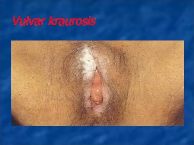 Vulvar kraurosis