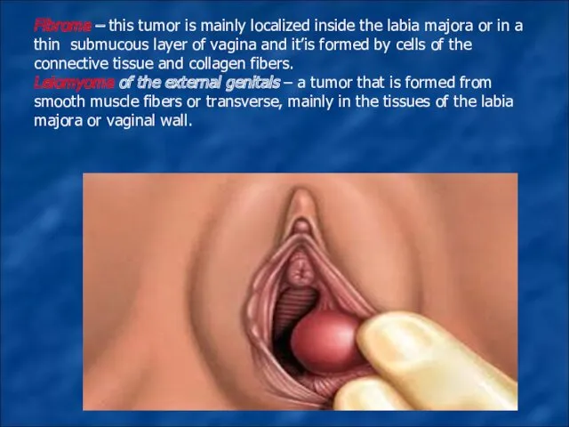 Fibroma – this tumor is mainly localized inside the labia