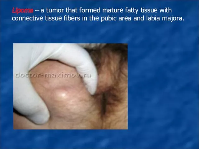 Lipoma – a tumor that formed mature fatty tissue with