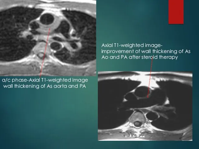a/c phase-Axial T1-weighted image wall thickening of As aorta and