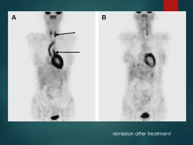 remission after treatment