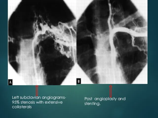 Left subclavian angiograms- 95% stenosis with extensive collaterals Post angioplasty and stenting.