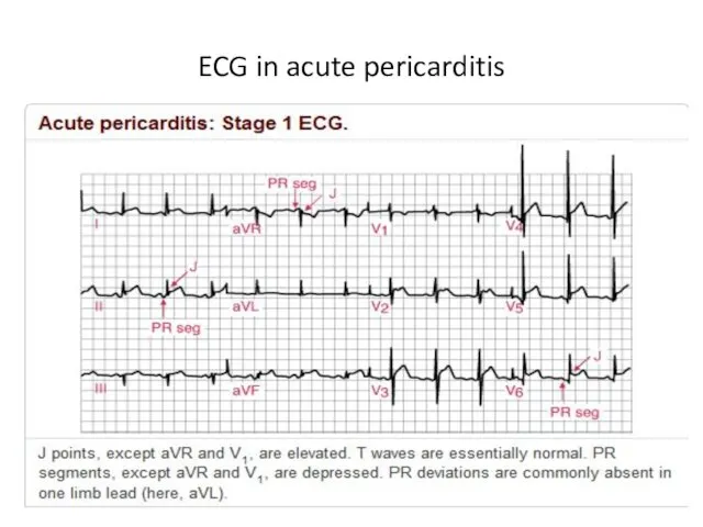 ECG in acute pericarditis